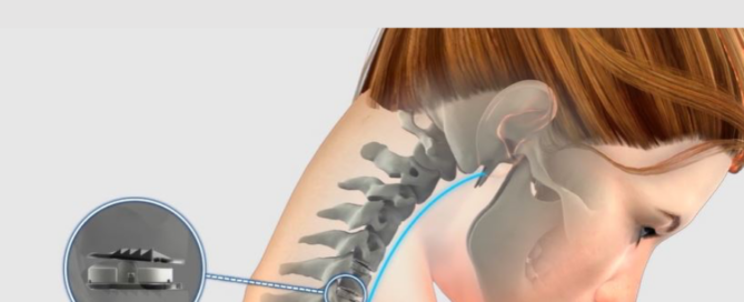 Illustrtion of Mobi-C Cervical Disc Replacement