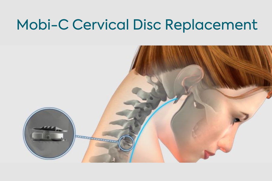 Illustrtion of Mobi-C Cervical Disc Replacement