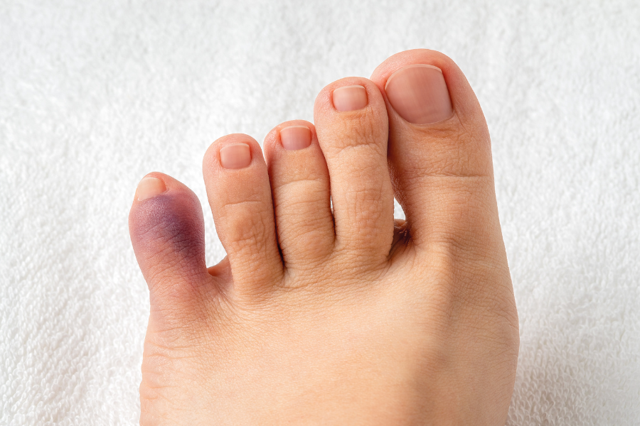 How Do I Know If My Toe is Broken?