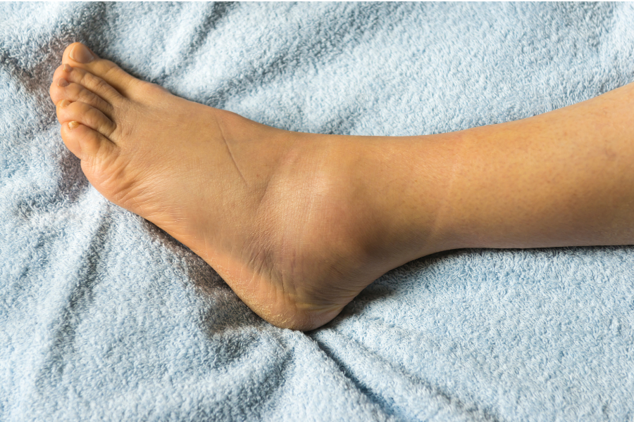 Is My Child's Ankle Broken? - Coastal Orthopedics