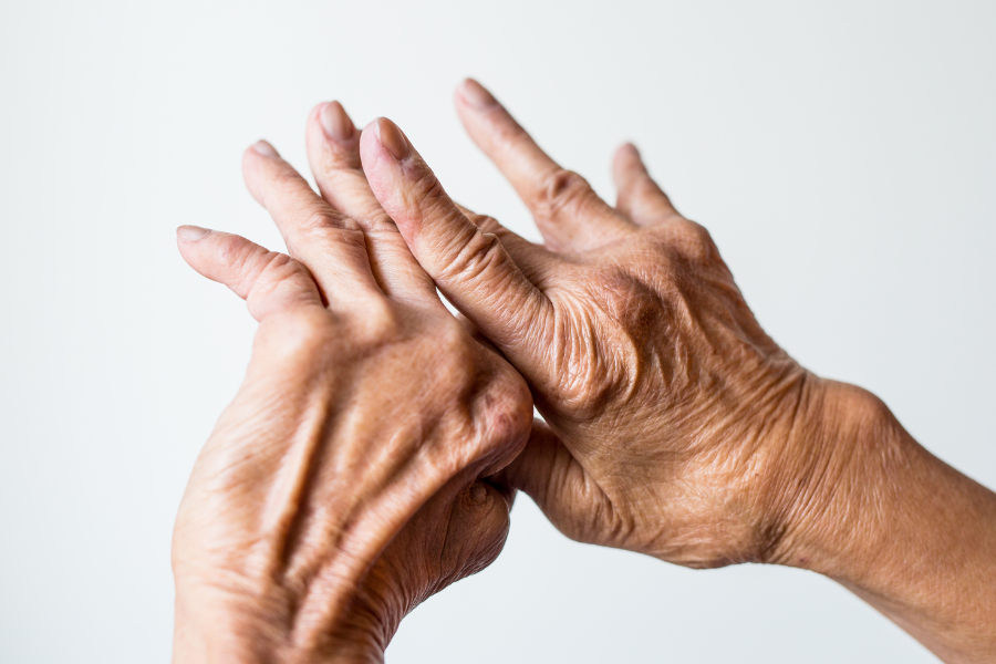 hands of a senior citizen with swollen knuckles and finger joints