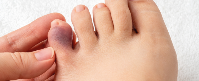 foot with bruised toe