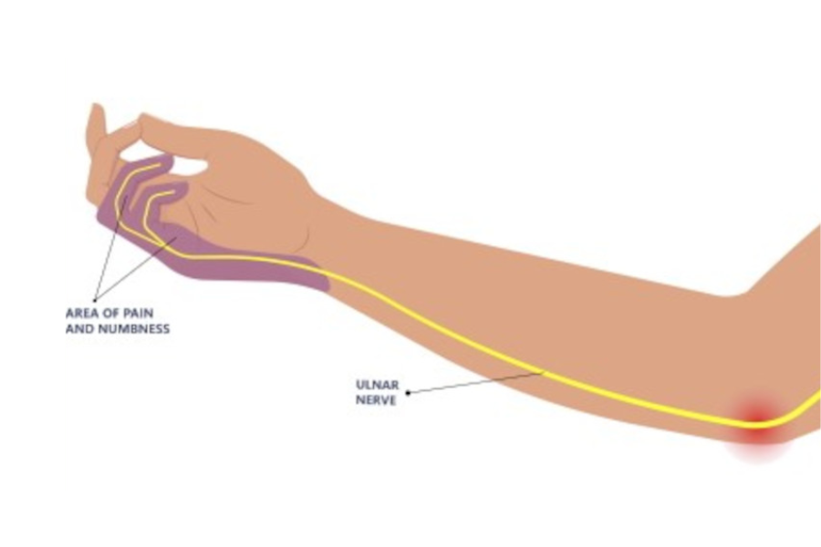 Ulnar nerve entrapment