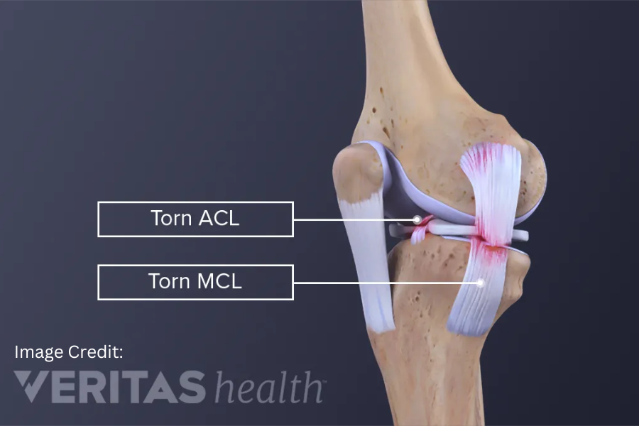 What Is the Difference Between an ACL Tear and an MCL Tear